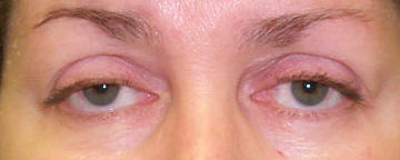 A photograph showing ptosis and blepharoplasty surgical procedure, with before and after images displayed. Width: 294 pixels. Height: 123 pixels.